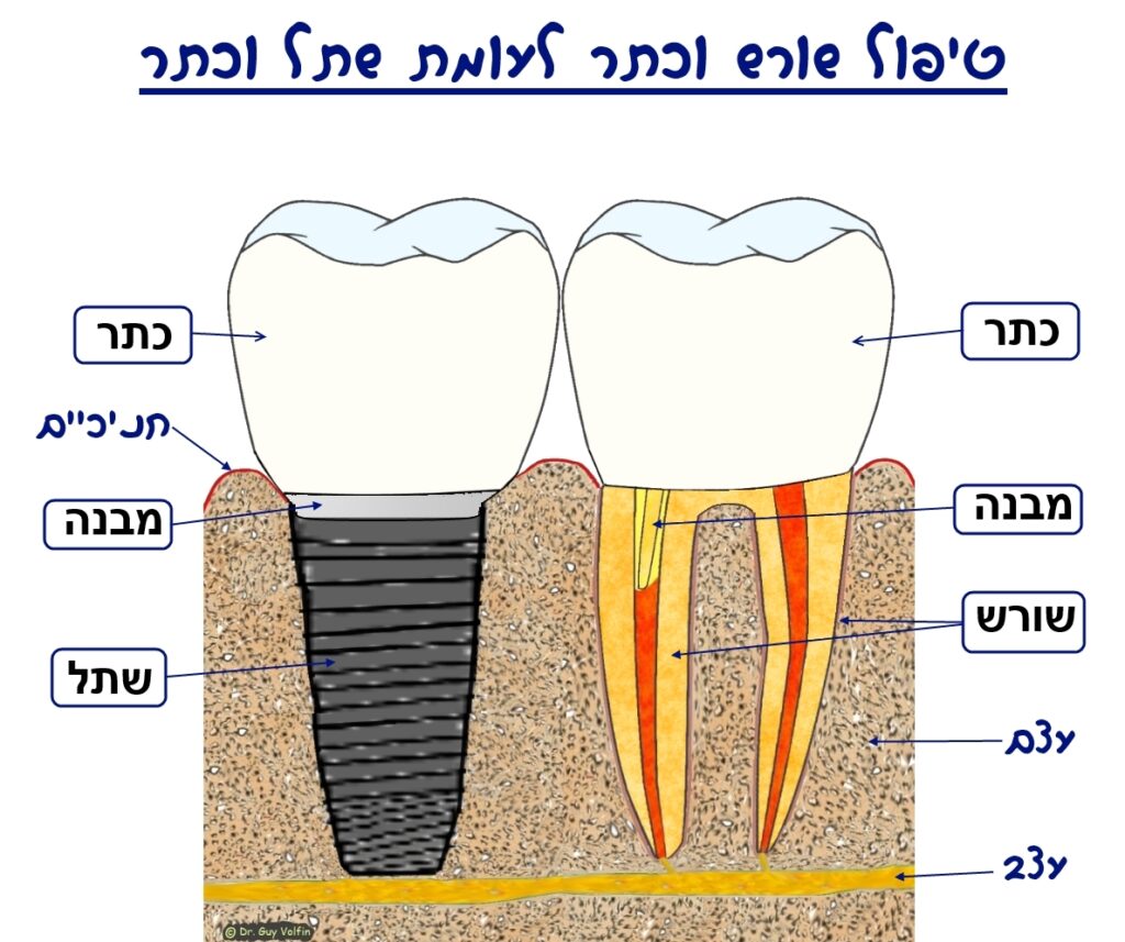 שתלים ברפואת שיניים - מהו השתל, איך מבצעים, למה הוא משמש? - ההסתדרות ...