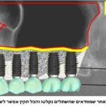 הרמת סינוס, השתלת עצם ושתלים דנטליים 5