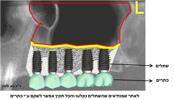 מאמר הרמת סינוס, השתלת עצם ושתלים דנטליים