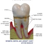 מחלת חניכיים - periodontitis