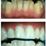 לפני ואחרי הלבנת שיניים