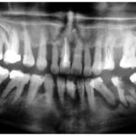 מחלת חניכיים חמורה מפושטת severe chronic peridontitis - ד''ר גיא וולפין - פנורמי