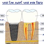 שתל וכתר לעומת טיפול שורש וכתר