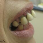 תזוזות שיניים - קריסת משנן אחורי - flaring 2