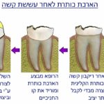 הארכת כותרת בגין הרס כותרתי מעששת - וולפין