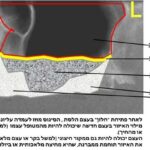 הרמת סינוס, השתלת עצם ושתלים דנטליים 3