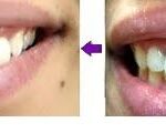 רווח בין השיניים ציפוי חרסינה
