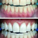 הלבנת שיניים תוך שעה במרפאה - זום  