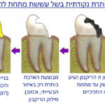 הארכת כותרת בגין עששת מתחת לקו החניכיים - וולפין