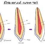 ציפוי חרסינה לשיניים למינייטס חזיתית לומינירס EMAX וולפין
