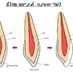 ציפוי חרסינה לשיניים למינייטס חזיתית לומינירס EMAX וולפין