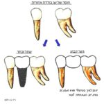 פתרונות לשן אחורית חסרה:  שתל בודד או גשר 3 שיניים
