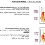 periodontitis מחלת חניכיים