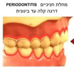 דלקת חניכיים ומחלת חניכיים  gingivitis periodontitis