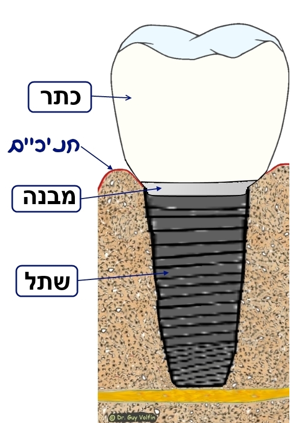 מאמר שתלים ברפואת שיניים – מהו השתל, איך מבצעים, למה הוא משמש?