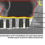 הרמת סינוס, השתלת עצם ושתלים דנטליים 4