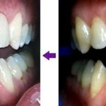 הלבנת שיניים zoom  וארבעה ציפויי חרסינה emax אסתטיקה דנטלית