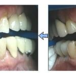 הלבנת שיניים תוך שעה במרפאה