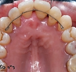 ספלינט – לאחר יישור השיניים