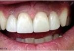 הלבנת שיניים, ציפויי חרסינה EMAX, הלבנה ZOOM, ניתוח לייזר בחניכיים (1)
