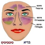 סינוסיטיס