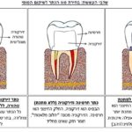 כתרים ברפואת שיניים - סוגים נפוצים