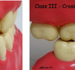 תמונה של שיניים עם הפרעת סגר מסוג class III