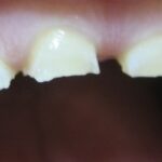 ברוקסיזם, שחיקה של השיניים, חשיפת דנטין, שברים בשיניים, TMD