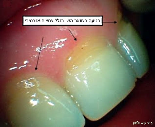 מאמר צחצוח אגרסיבי (צחצוח יתר, אברזיה) והנזקים הנגרמים לשיניים ולחניכיים