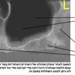 הרמת סינוס, השתלת עצם ושתלים דנטליים 1