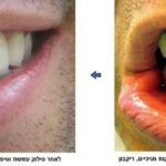 כתרים זולים לעומת כתרי זירקוניה