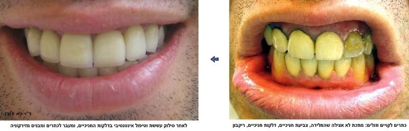 מאמר סוגי כתרים נפוצים ברפואת שיניים