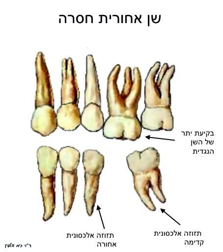 מאמר שתל או גשר? חוסר שיניים והפרעות סגר– למה חשוב לשחזר שיניים חסרות?