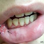 אפטה פצע שורף ברירית הפה וולפין