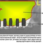 הרמת סינוס, השתלת עצם ושתלים דנטליים 2