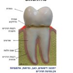 דלקת חניכיים - gingivitis